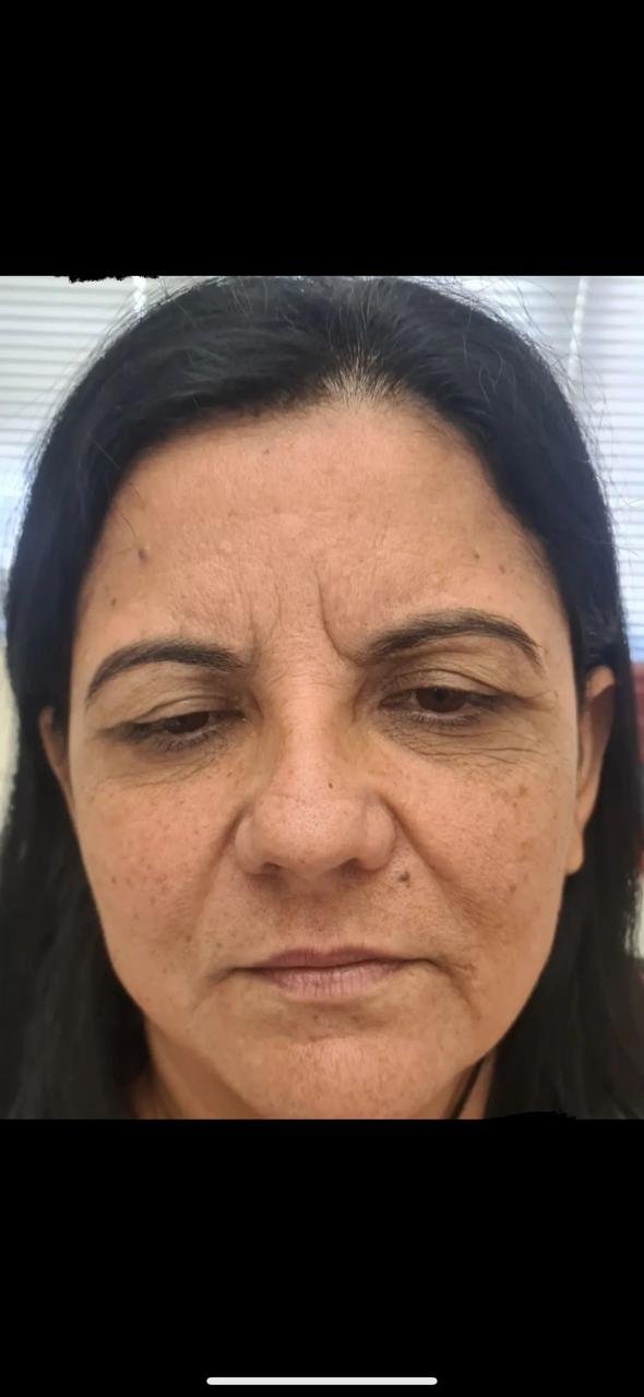 Antes do procedimento - paciente 2