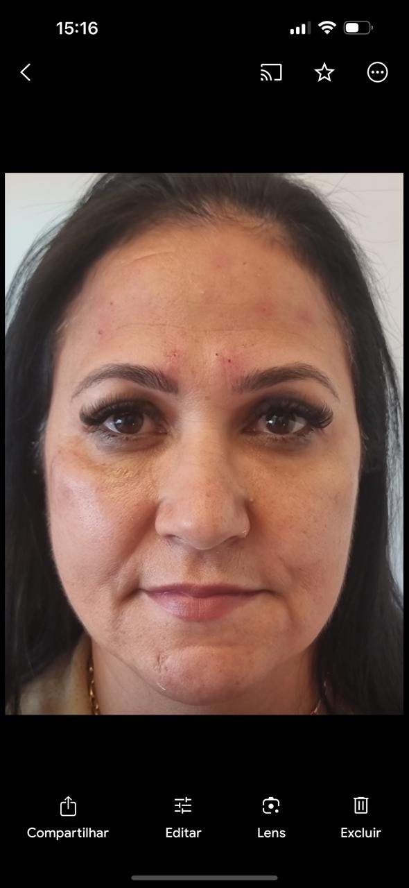 Antes do procedimento - paciente 3