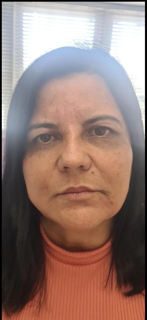 Depois do procedimento - paciente 2